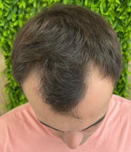 confira o antes e depois de um implante capilar 2 – antes confira o antes e depois de um implante capilar 2 - antes