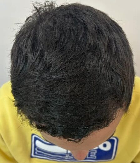 confira o antes e depois de um implante capilar 2 - depois
